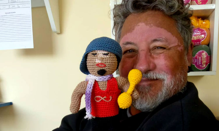 Hombre con vitíligio crea muñecas y genera consciencia sobre distintas enfermedades